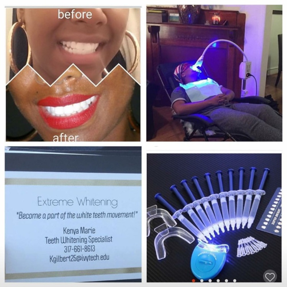 Teeth whitening kits